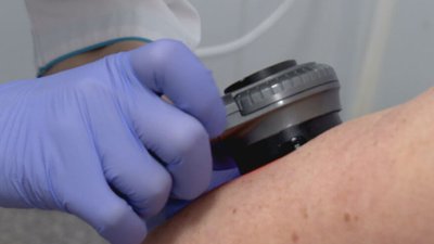 У День меланоми мешканці Києва мають змогу безоплатно оглянути родимки без потреби у направленні чи реєстрації заздалегідь.